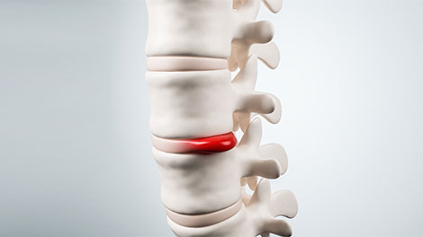 patient requiring disc Injuries treatment in Hayward CA
