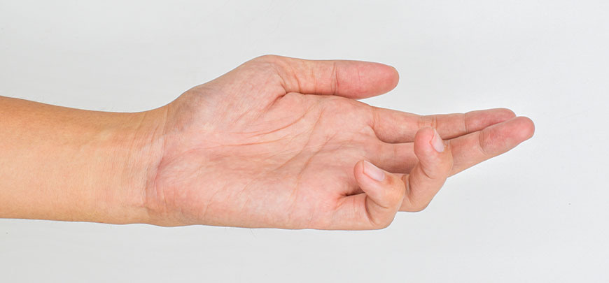 patient needing Dupuytren Contracture treatment in Hayward