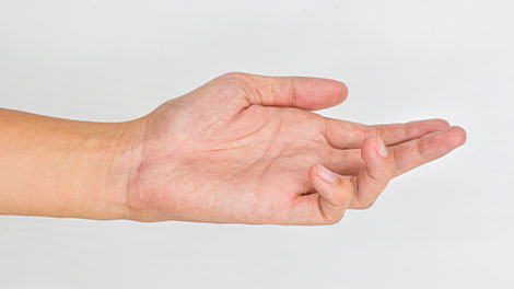 patient requiring dupuytren contracture treatment in Hayward CA