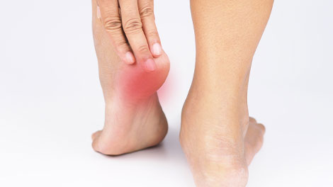 patient requiring plantar Fasciitis treatment in Hayward CA