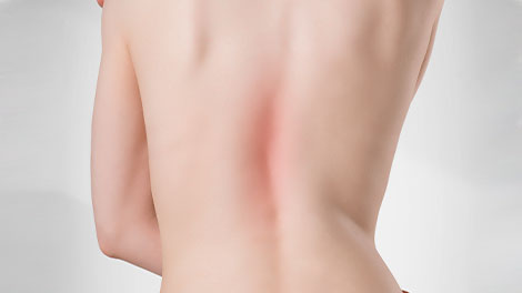patient requiring scoliosis treatment in Hayward CA