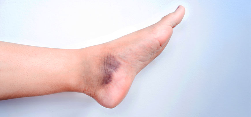 patient needing sprain treatment in Hayward