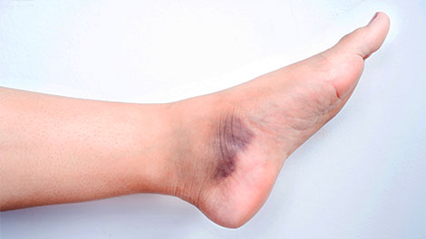 patient requiring sprain treatment in Hayward CA