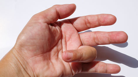 patient requiring trigger finger treatment in Hayward CA